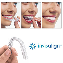 invisalign tarif price cost