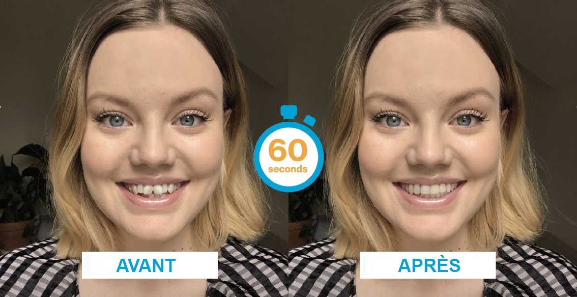 Invisalign SmileView