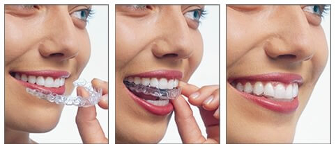 appareil dentaire invisible invisalign